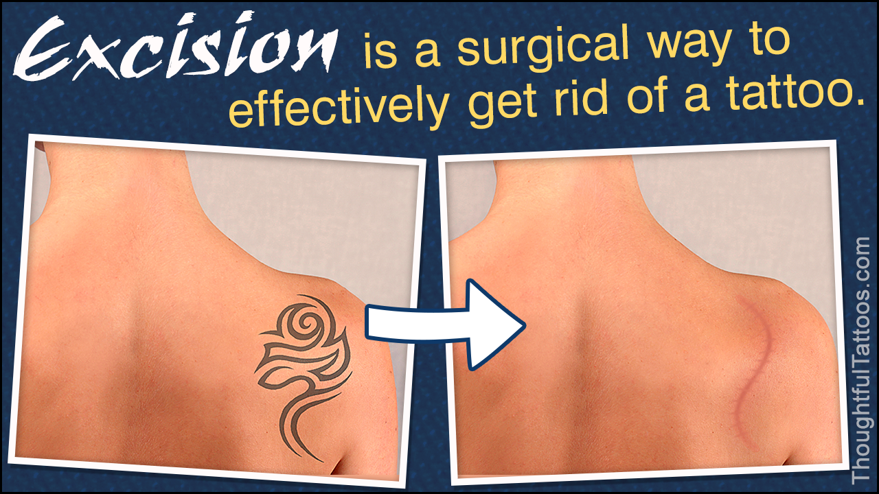 8. Surgical Excision for Tattoo Removal - wide 6